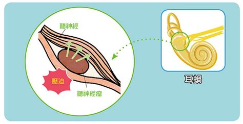 右耳鳴|耳鳴原因有3種，一直耳鳴怎麼辦？舒緩耳鳴症狀醫師。